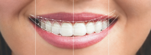 Digital Smile Design (DSD) - Ψηφιακός Σχεδιασμός Χαμόγελου